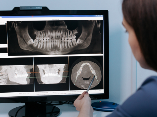 Dental implants