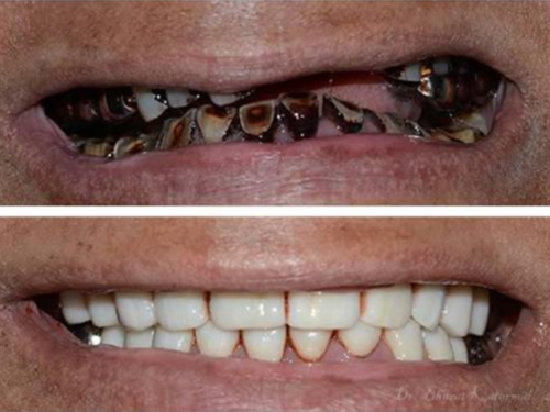 Full Mouth Rehabilitation