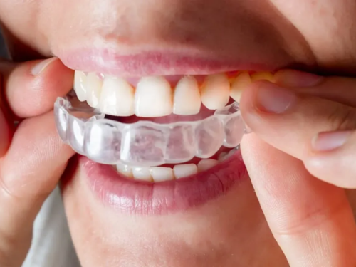 Invisalign Aligners
