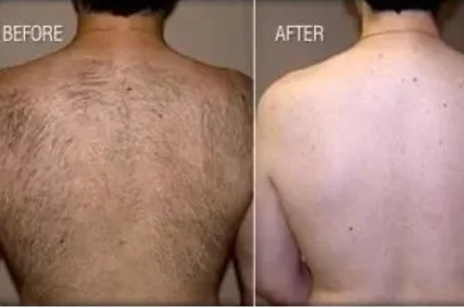 Laser Hair Reduction