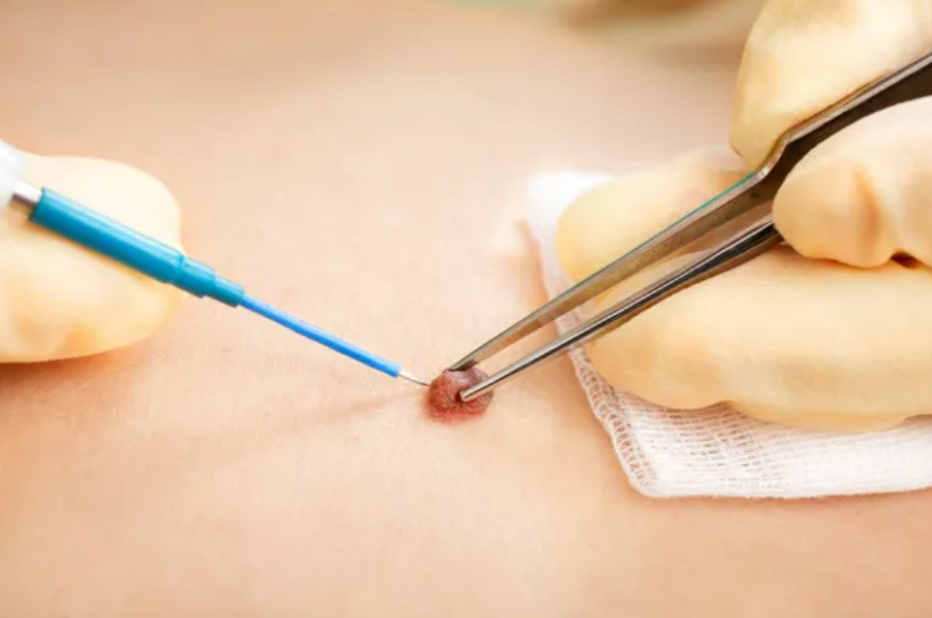 Mole Removal