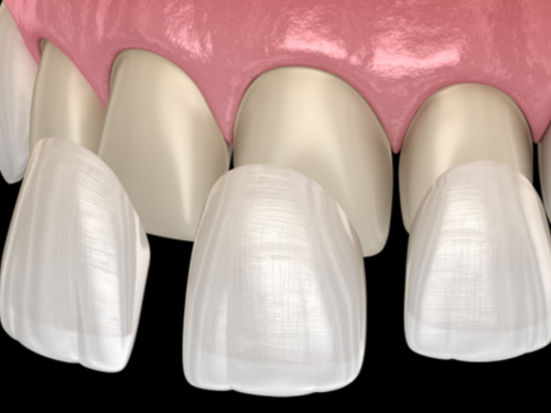 Veneers & Laminates