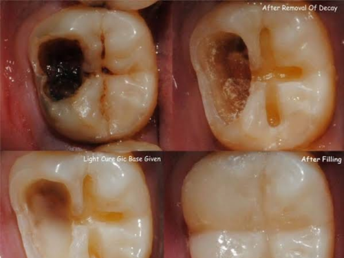 dental fillings
