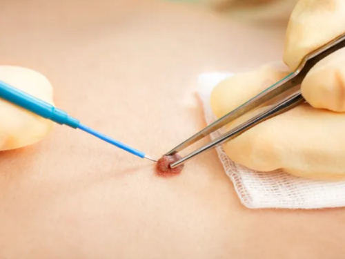 Mole Removal