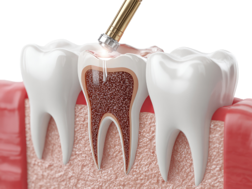 Root Canal